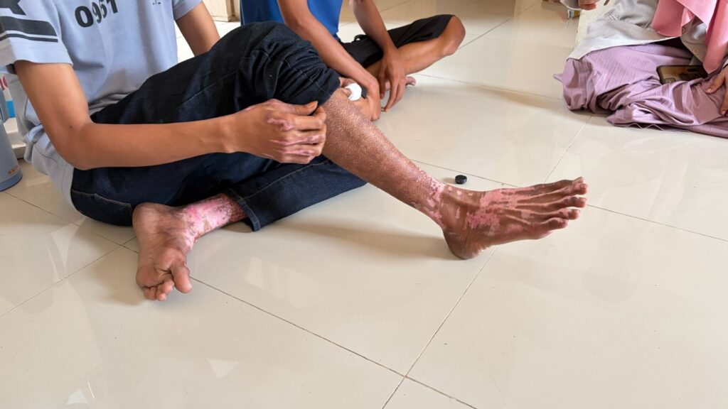 bantuan pemulihan luka untuk korban kebakaran SPBE Cimuning